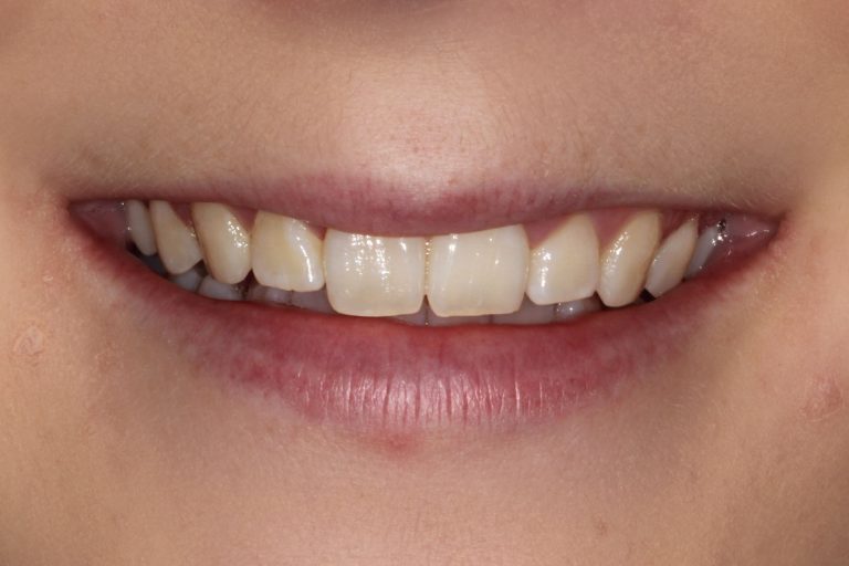 Tänder före tandblekning